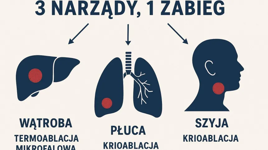 Warszawa/Trzy narządy zoperowane w jednym małoinwazyjnym zabiegu przez specjalistów WUM