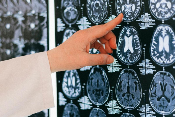 Znaleziono biomarker mózgu, który może umożliwić wczesne wykrycie choroby Alzheimera - INFBusiness