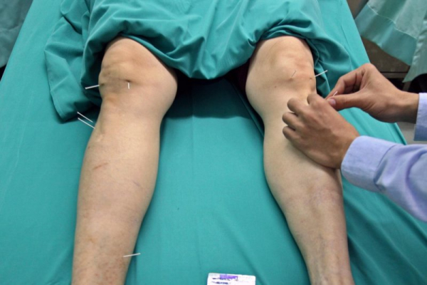 Naukowcy badają możliwość leczenia radioterapii zapaleniem stawów kolanowych