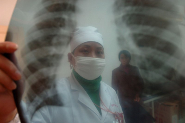 Według naukowców, zgodnie z obowiązującymi wytycznymi dotyczącymi badań przesiewowych, prawie dwie trzecie Amerykanów z rakiem płuc nie kwalifikowałoby się do wymaganych badań. Zdjęcie archiwalne: Shou Sheng/EPA Under current screening guidelines, almost two-thirds of Americans with lung cancer would not have qualified for required scans, researchers said. File Photo by Shou Sheng/EPA