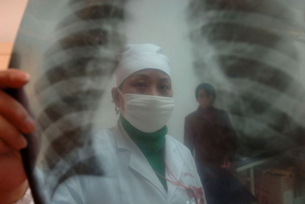 Rak płuc pozostaje najgroźniejszym nowotworem, ale pacjenci żyją dłużej